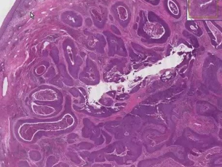 Rak płaskonabłonkowy - histopatologia - szyjka macicy