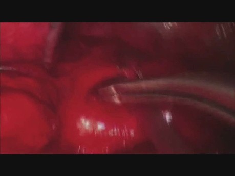Anatomiczna resekcja podstawnego segmentu w obrębie dolnego płata lewego pluca z pojedynczego dostępu sposobem VATS