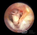 Tympanoskleroza błony śluzowej ucha środkowego
