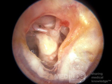 Tympanoskleroza błony śluzowej ucha środkowego