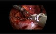 Prawostronna adrenalektomia laparoskopowa u 9 miesięcznego niemowlęcia