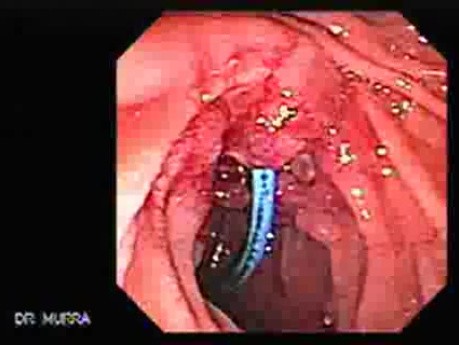 Gruczolakorak brodawki Vatera - migracja stentu (7 z 7)