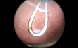 Mikrohisteroskopia – porady i wskazówki dotyczące zwężenia ujścia zewnętrznego kanału szyjki macicy