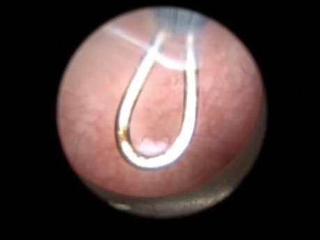 Mikrohisteroskopia – porady i wskazówki dotyczące zwężenia ujścia zewnętrznego kanału szyjki macicy