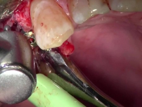 Nacięcie i wycięcie dziąsła wokół implantu w celu założenia śruby zamykającej - #5