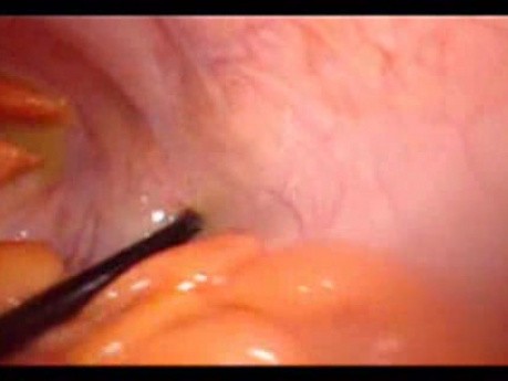 Perforacja okrężnicy z zapaleniem otrzewnej - laparoskopia (30 z 46)