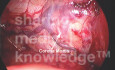 Wieniec śmierci (Corona Mortis) w widoku laparoskopowym