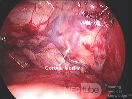 Wieniec śmierci (Corona Mortis) w widoku laparoskopowym