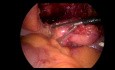 Chirurgia laparoskopowa wycięcia guza moczownika