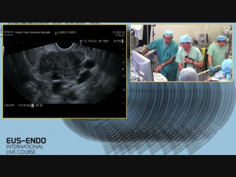 Ultrasonografia endoskopowa (EUS) z użyciem środka kontrastowego (SonoVue) i biopsją aspiracyjną cienkoigłową (FNB)