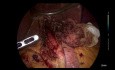 Laparoskopowa kardiomiotomia Hellera + fundoplikacja Dora