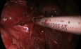 Wideotorakoskopowe usunięcie płata płuca we wrodzonej gruczolatowatości trobielowatej płuc