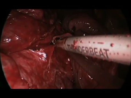 Wideotorakoskopowe usunięcie płata płuca we wrodzonej gruczolatowatości trobielowatej płuc