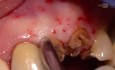 Ekstrakcja zęba i natychmiastowe wszczepienie implantu (technika bezpłatowa)