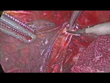 Technika golenia w endometriozie odbytnicy