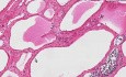 Lymphangioma (cystic hygroma) - Badanie histopatologiczne szyi