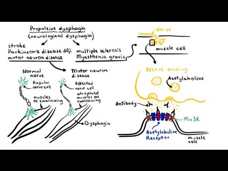 Dysfagia - przyczyny, patofizjologia, klasyfikacja i diagnostyka różnicowa