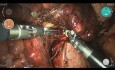 Resekcja klinowa prawego płata środkowego, mrożenie skrawków (gruczolakorak), lobektomia środkowa i limfadenektomia za pomocą robota chirurgicznego Versius