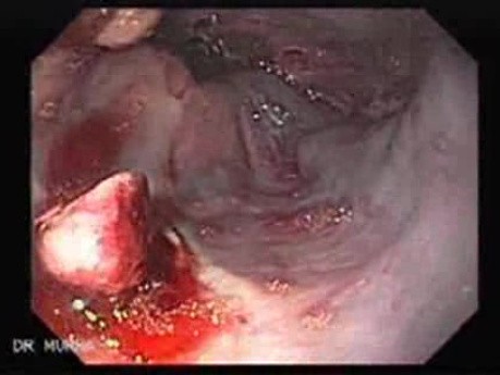 Ostre krwawienie z górnego odcinka przewodu pokarmowego - 2 dni po założeniu podwiązki - wprowadzenie argonowego koagulatora plazmowego