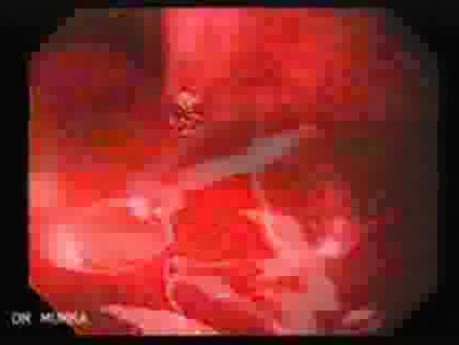 Ostre krwawienie z górnego odcinka przewodu pokarmowego - 2 dni po założeniu podwiązki - rozległe krwawienie