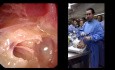 Endoskopowa operacja ucha - część I