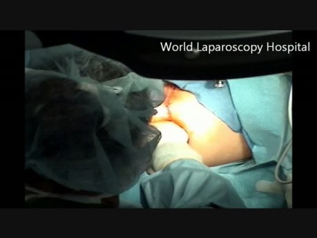 Transanalna mikrochirurgia endoskopowa