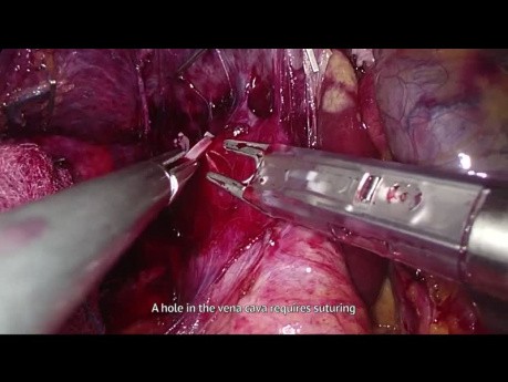 Hemihepatektomia prawostronna metodą laparoskopową - szycie żyły głównej dolnej, krwawienie z miąższu wątroby