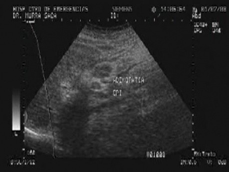 Rak jajnika z przerzutami do żołądka i dwunastnicy - USG jamy brzusznej, część 1