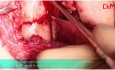 Osteosynteza niskiego złamania szyjki wyrostka kłykciowego żuchwy.
