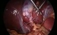 Szycie i wiązanie laparoskopowe
