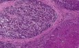 Rak wątrobowokomórkowy w przebiegu marskości - histopatologia - wątroba
