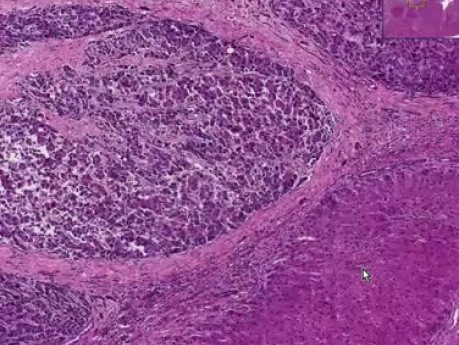 Rak wątrobowokomórkowy w przebiegu marskości - histopatologia - wątroba