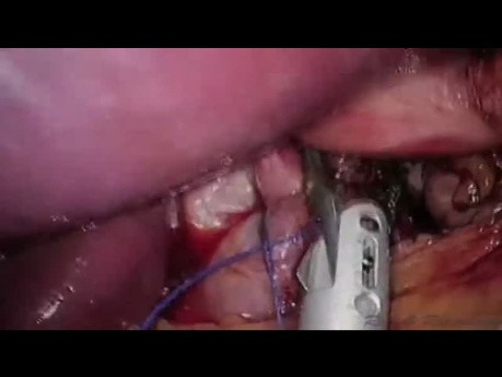 Laparo-endoskopowa jednomiejscowa (LESS) fundoplikacja sposobem Toupeta wraz z cholecystektomią