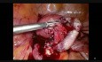 Endometrioza - Laparoskopowe wyłuszczenie guza jajnika 
