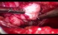 Endoskopowe wycięcie olbrzymiego gruczolakowłókniaka