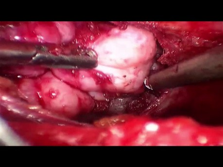 Endoskopowe wycięcie olbrzymiego gruczolakowłókniaka