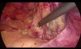 Sigmoidektomia laparoskopowa - mobilizacja zagięcia śledzionowego od boku do strony przyśrodkowej