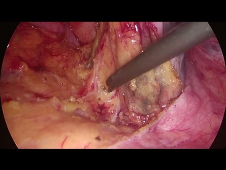 Sigmoidektomia laparoskopowa - mobilizacja zagięcia śledzionowego od boku do strony przyśrodkowej
