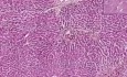Przewlekłe przekrwienie wątroby z krwotoczną, śródzrazikową martwicą - histopatologia