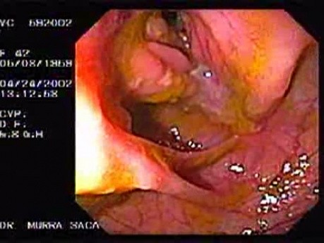 Choroba Leśniowskiego - Crohna - endoskopia (3 z 28)