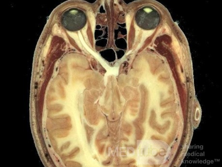 Anatomiczny stosunek między zatoką klinową i nerwem wzrokowym