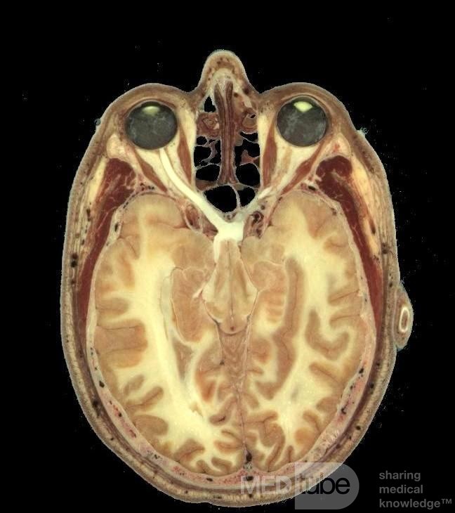 Anatomiczny stosunek między zatoką klinową i nerwem wzrokowym