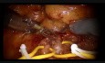 Częściowa resekcja nerki w asyście robota chirurgicznego 