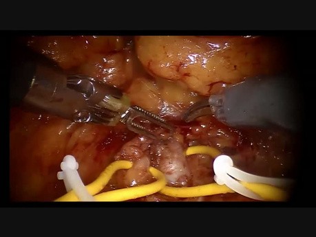 Częściowa resekcja nerki w asyście robota chirurgicznego 