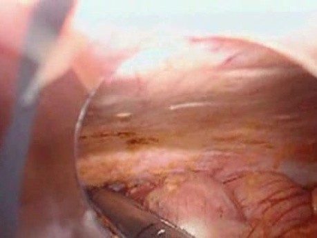 Perforacja okrężnicy z zapaleniem otrzewnej - laparoskopia (7 z 46)