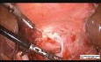 Laparoskopowa hysterektomia