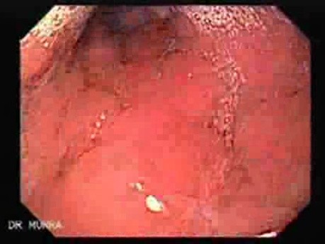 Rak włóknisty żołądka - endoskopia (1 z 47)