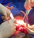 Przepuklina oponowa u 18-letniego pacjenta