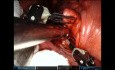 Jednoportowa w pełni robotyczna anatomiczna segmentektomia S6 lewa i hybrydowa robotyczna segmentektomia S6 prawa
