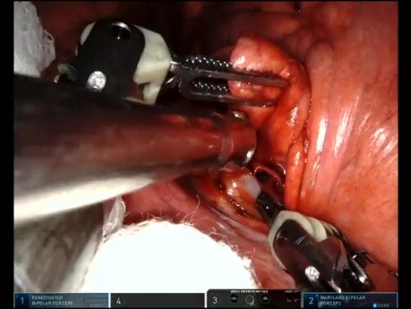 Jednoportowa w pełni robotyczna anatomiczna segmentektomia S6 lewa i hybrydowa robotyczna segmentektomia S6 prawa